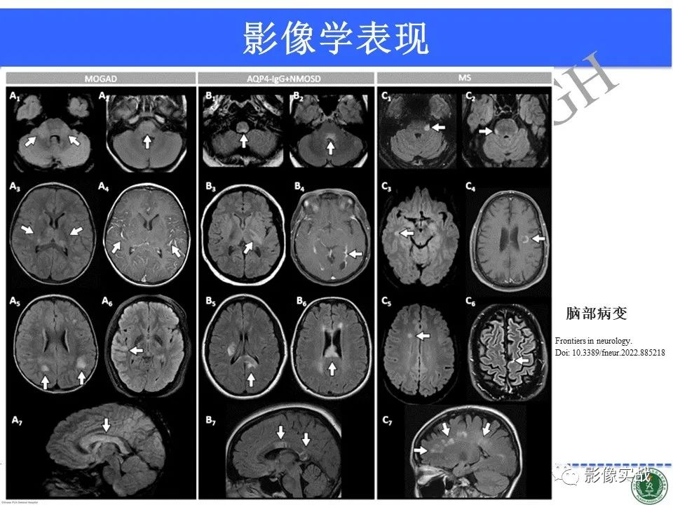 影像PPT - 【病例】髓鞘少突胶质细胞糖蛋白抗体相关疾病(MOG抗体相关疾病)-39