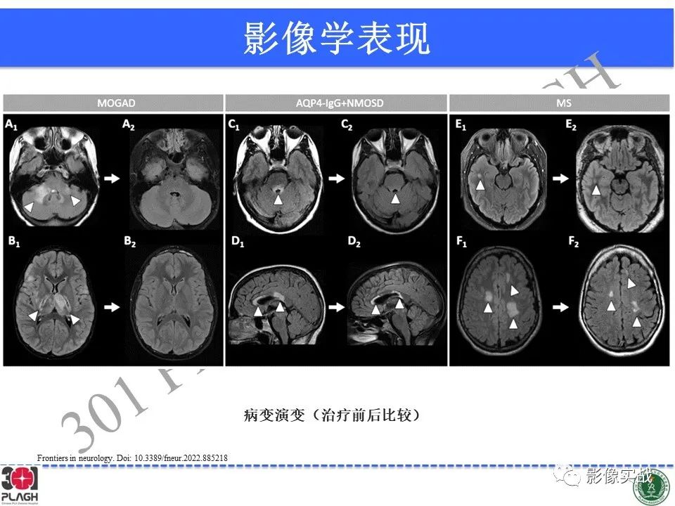 影像PPT - 【病例】髓鞘少突胶质细胞糖蛋白抗体相关疾病(MOG抗体相关疾病)-41