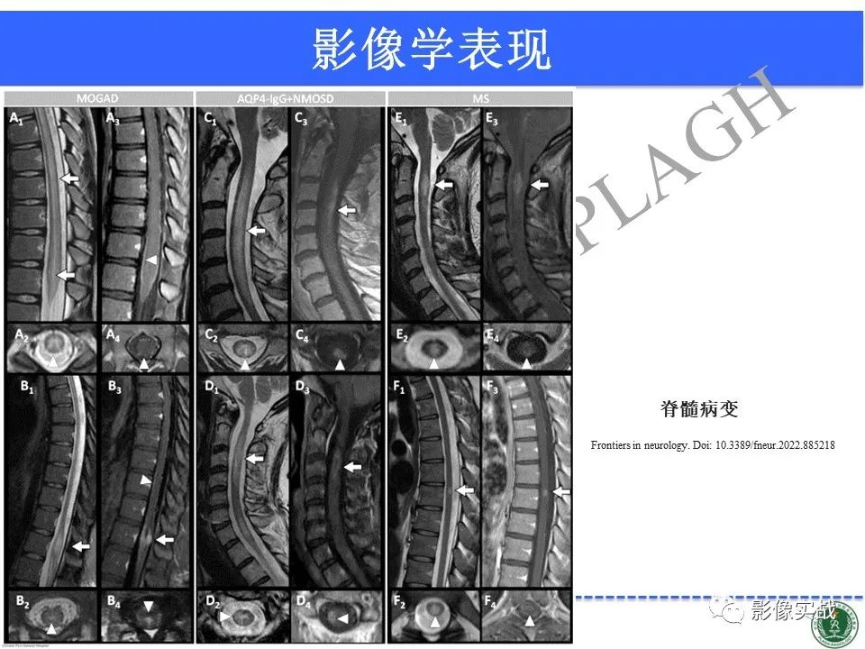 影像PPT - 【病例】髓鞘少突胶质细胞糖蛋白抗体相关疾病(MOG抗体相关疾病)-40
