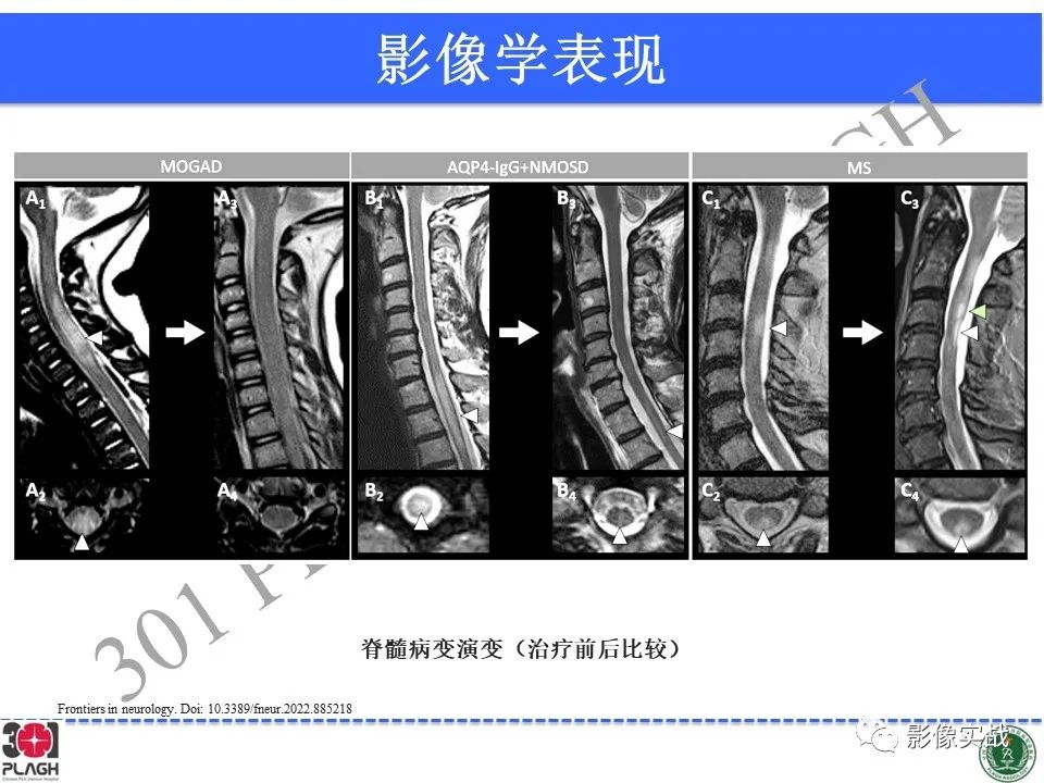 影像PPT - 【病例】髓鞘少突胶质细胞糖蛋白抗体相关疾病(MOG抗体相关疾病)-42