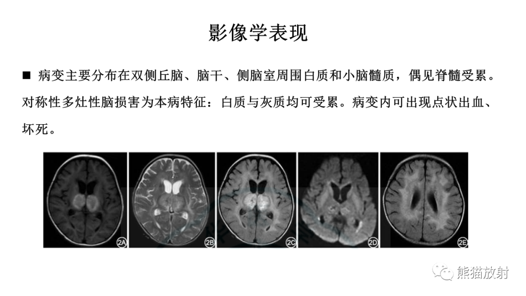 影像PPT - 【病例】急性坏死性脑病 VS 弥漫性中线胶质瘤-18
