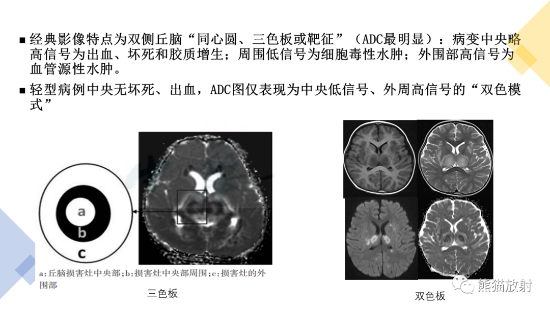 影像PPT - 【病例】急性坏死性脑病 VS 弥漫性中线胶质瘤-19