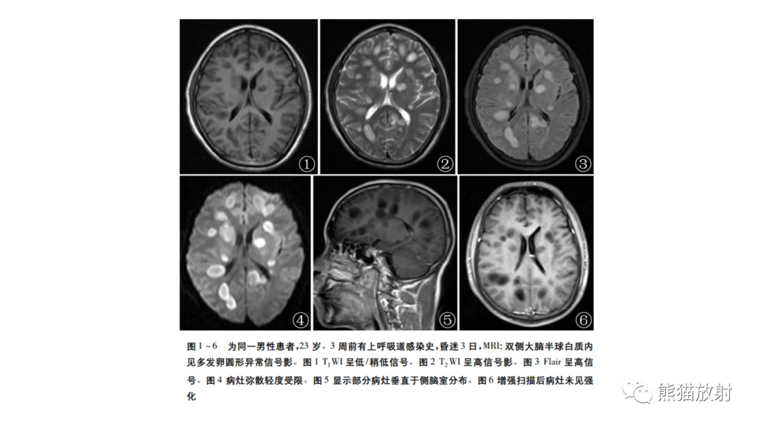 影像PPT - 【病例】急性坏死性脑病 VS 弥漫性中线胶质瘤-21