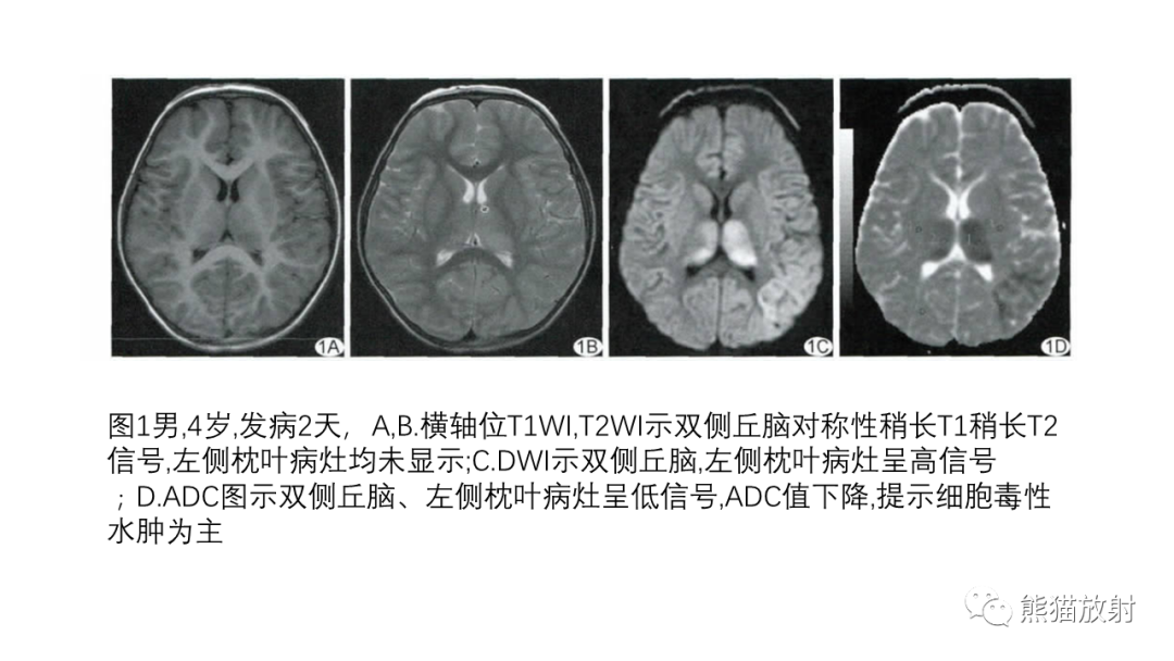 影像PPT - 【病例】急性坏死性脑病 VS 弥漫性中线胶质瘤-23
