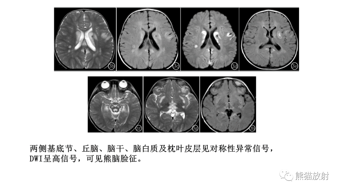 影像PPT - 【病例】急性坏死性脑病 VS 弥漫性中线胶质瘤-25