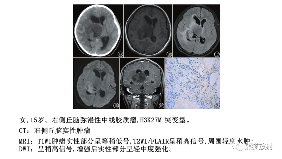 影像PPT - 【病例】急性坏死性脑病 VS 弥漫性中线胶质瘤-30