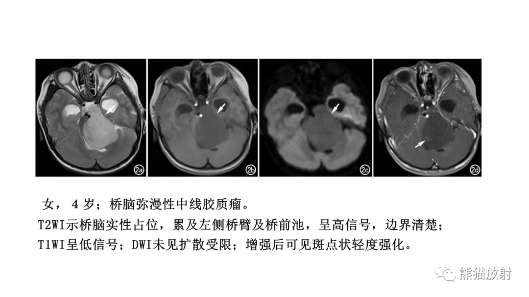 影像PPT - 【病例】急性坏死性脑病 VS 弥漫性中线胶质瘤-31