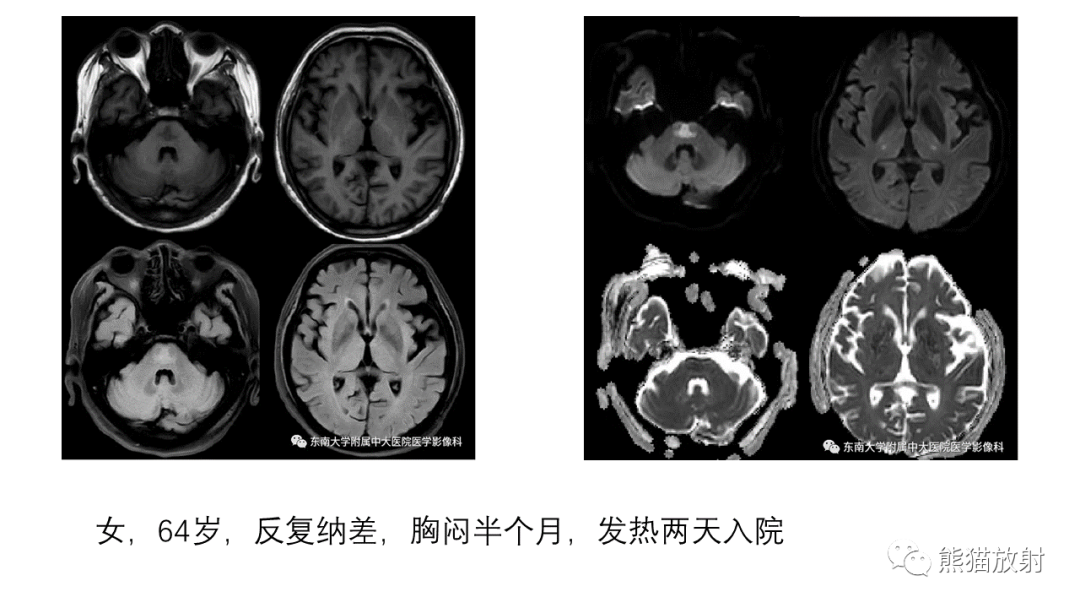 影像PPT - 【病例】急性坏死性脑病 VS 弥漫性中线胶质瘤-33