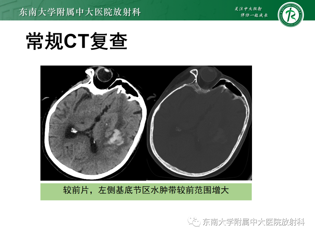 影像PPT - 【PPT】脑内出血和对比剂外渗鉴别—能谱CT的应用-4