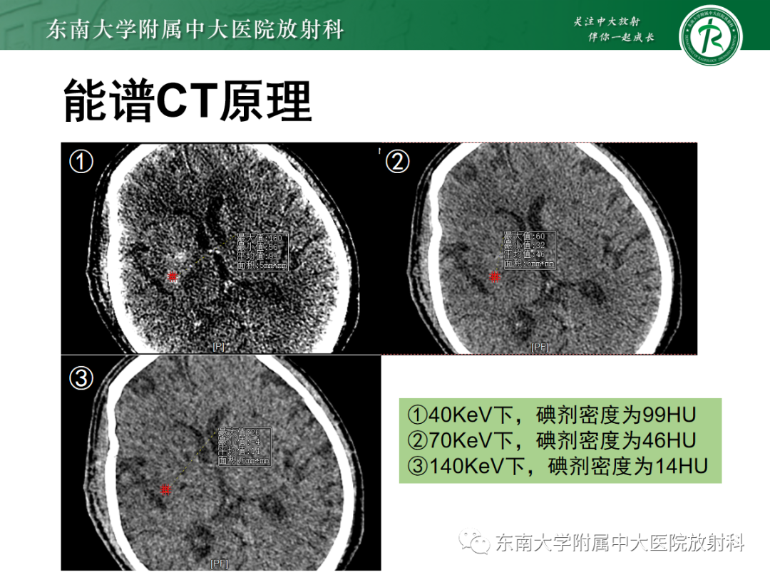 影像PPT - 【PPT】脑内出血和对比剂外渗鉴别—能谱CT的应用-12