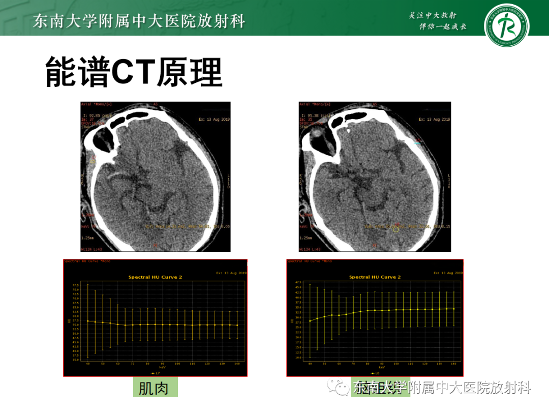 影像PPT - 【PPT】脑内出血和对比剂外渗鉴别—能谱CT的应用-14