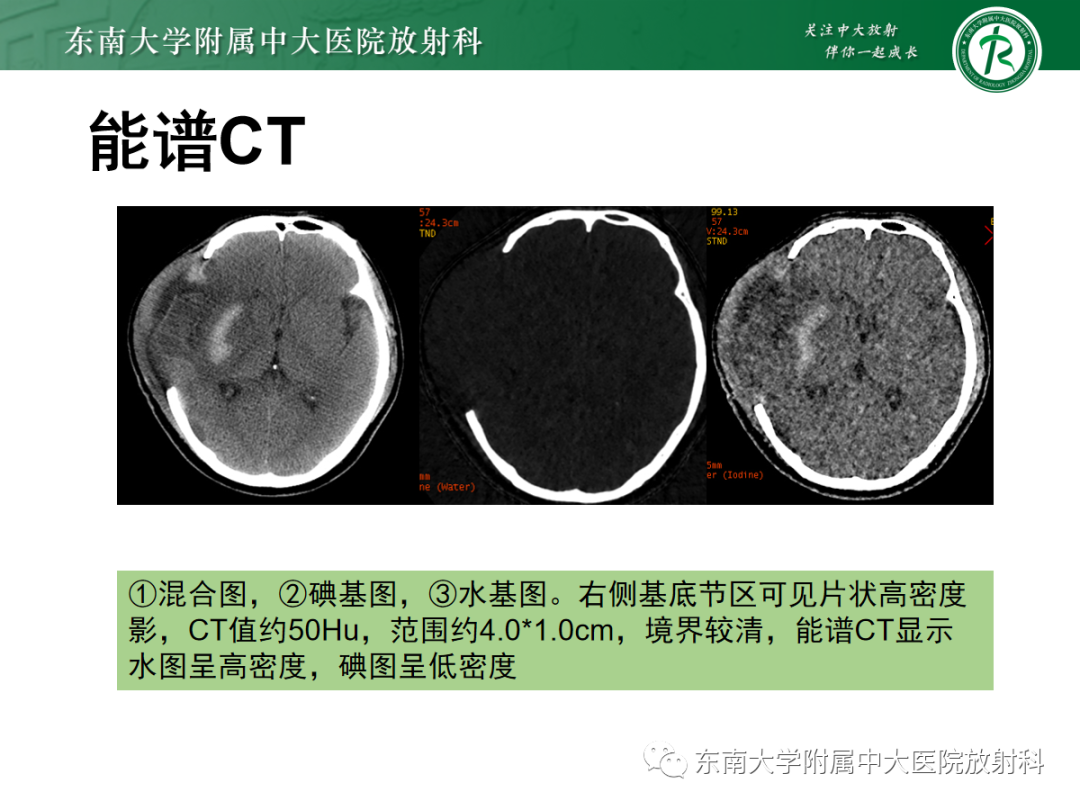 影像PPT - 【PPT】脑内出血和对比剂外渗鉴别—能谱CT的应用-20