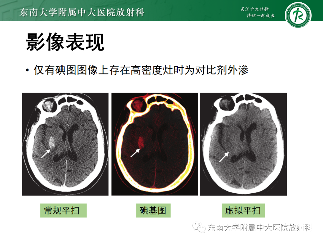 影像PPT - 【PPT】脑内出血和对比剂外渗鉴别—能谱CT的应用-21
