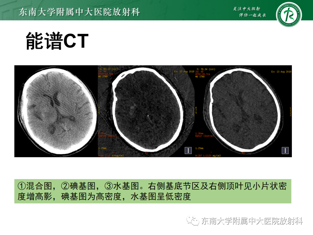 影像PPT - 【PPT】脑内出血和对比剂外渗鉴别—能谱CT的应用-25