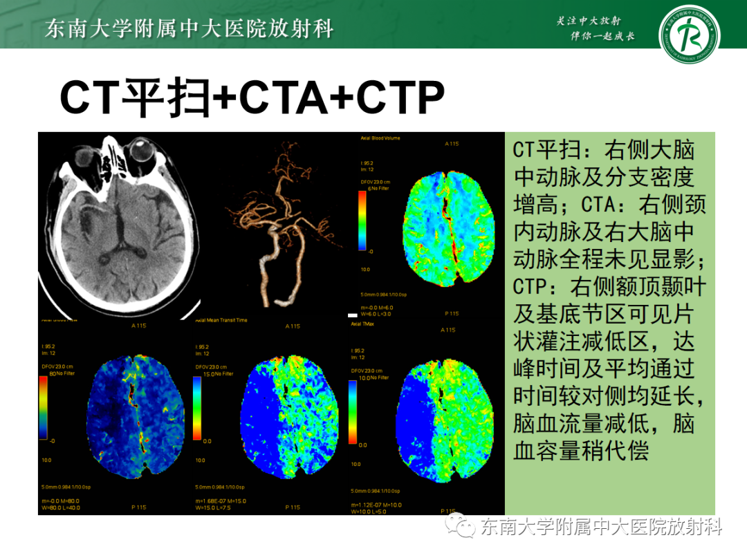 影像PPT - 【PPT】脑内出血和对比剂外渗鉴别—能谱CT的应用-23