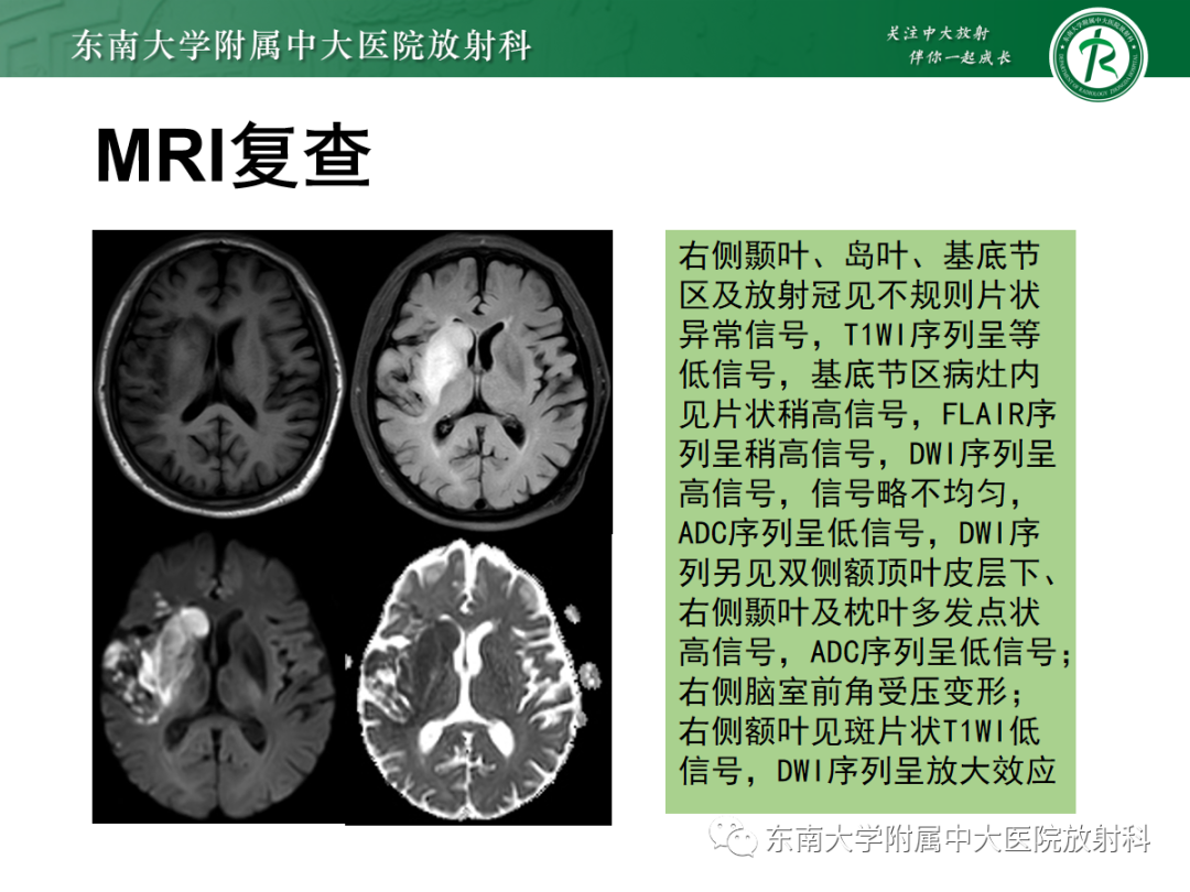 影像PPT - 【PPT】脑内出血和对比剂外渗鉴别—能谱CT的应用-26