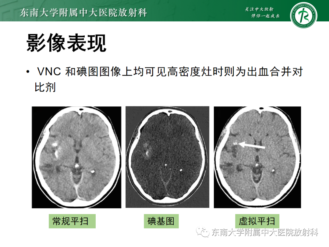 影像PPT - 【PPT】脑内出血和对比剂外渗鉴别—能谱CT的应用-27