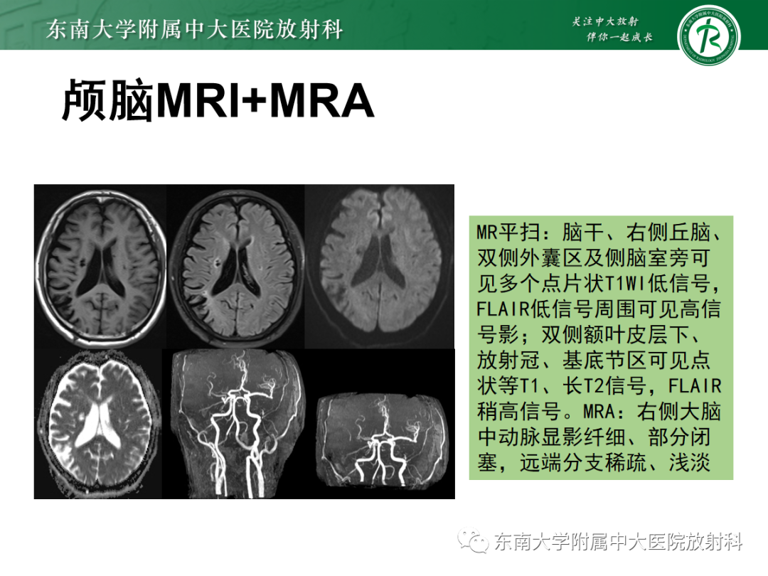 影像PPT - 【PPT】脑内出血和对比剂外渗鉴别—能谱CT的应用-29