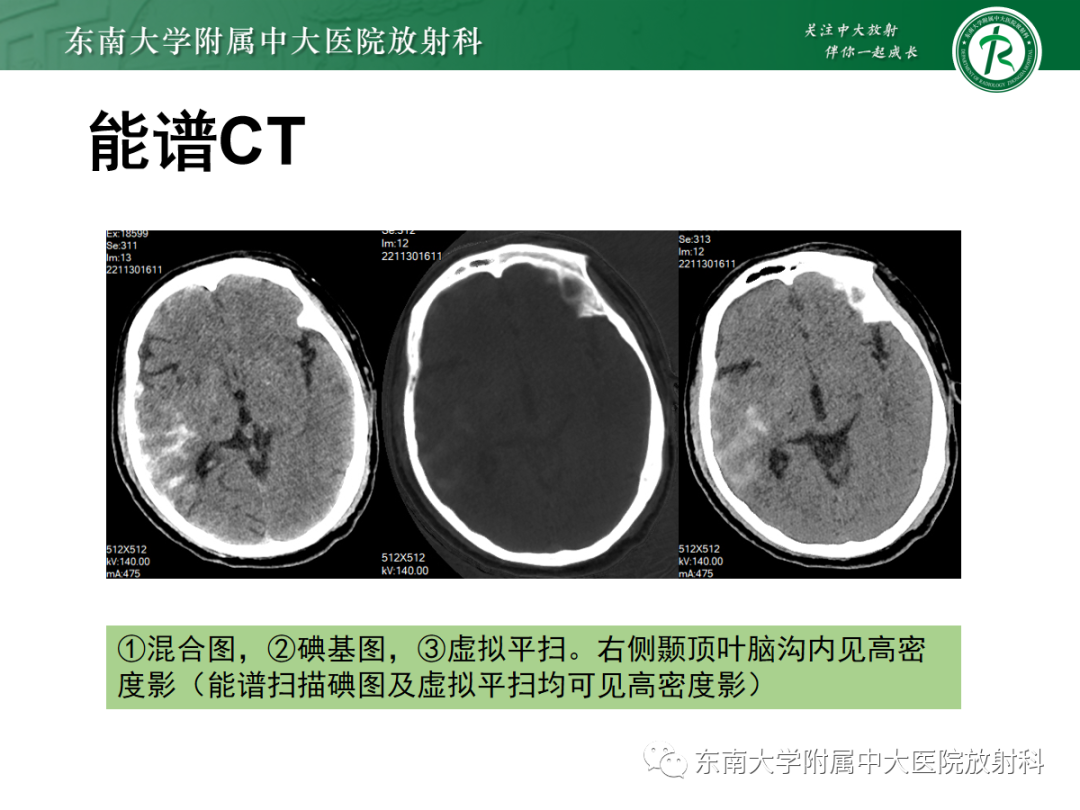 影像PPT - 【PPT】脑内出血和对比剂外渗鉴别—能谱CT的应用-31