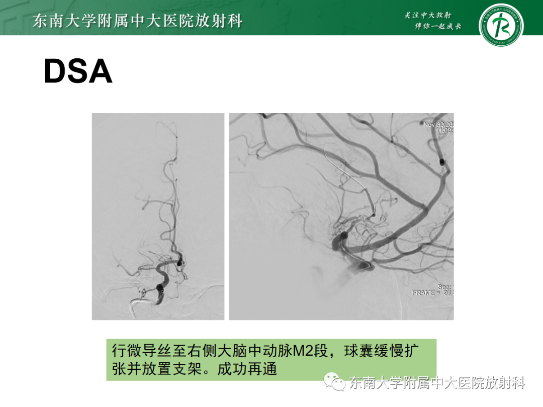 影像PPT - 【PPT】脑内出血和对比剂外渗鉴别—能谱CT的应用-30