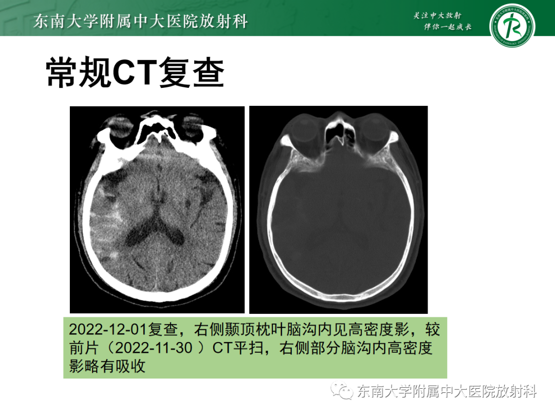 影像PPT - 【PPT】脑内出血和对比剂外渗鉴别—能谱CT的应用-32