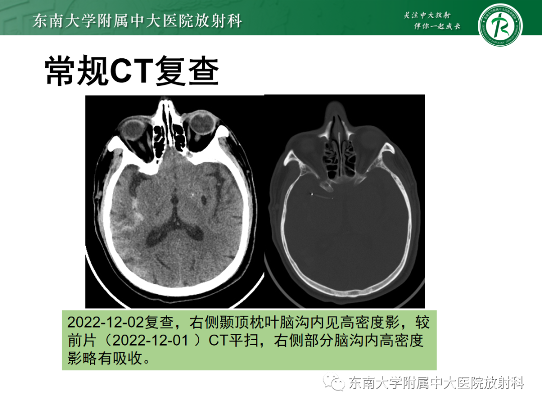影像PPT - 【PPT】脑内出血和对比剂外渗鉴别—能谱CT的应用-33