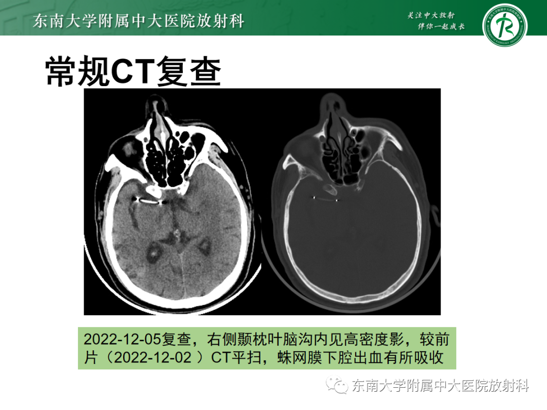 影像PPT - 【PPT】脑内出血和对比剂外渗鉴别—能谱CT的应用-34