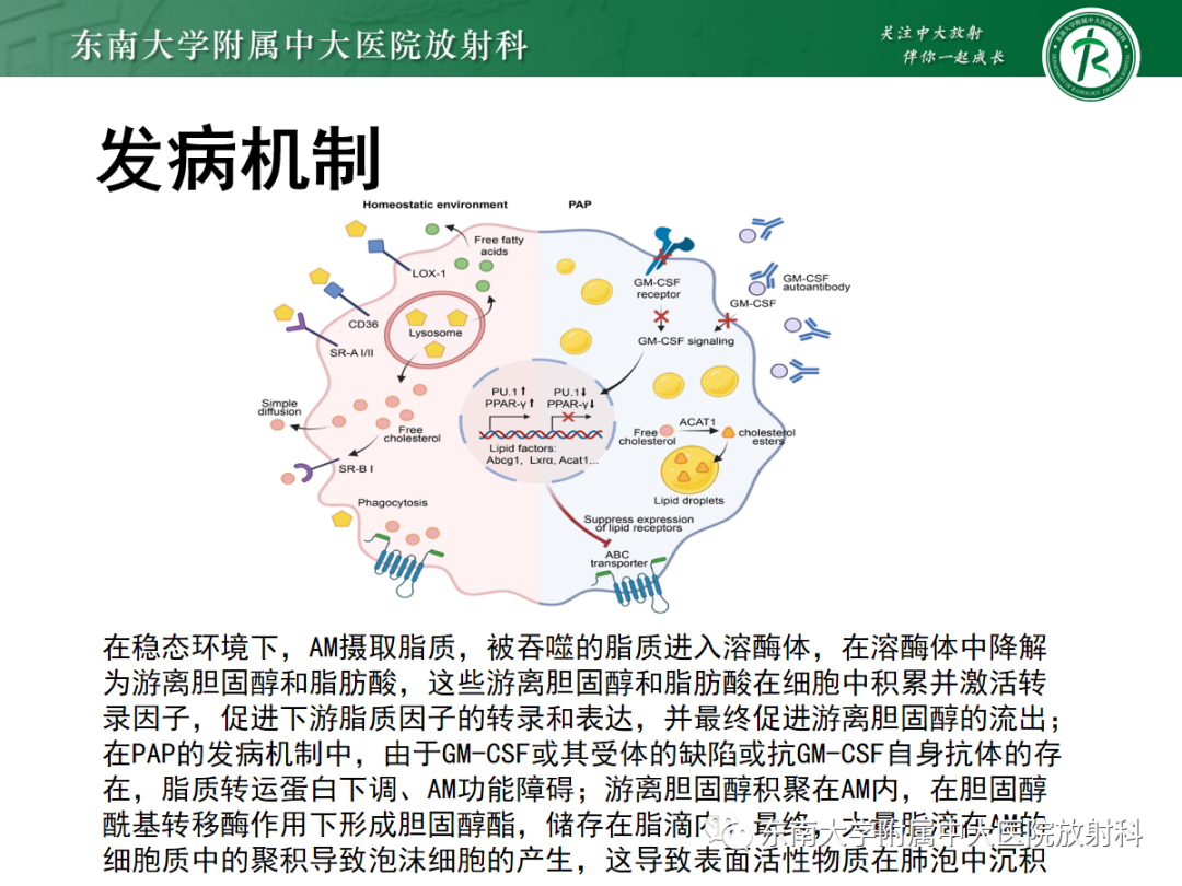 影像PPT - 【PPT】肺泡蛋白沉积症-10