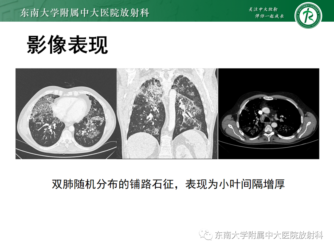 影像PPT - 【PPT】肺泡蛋白沉积症-14