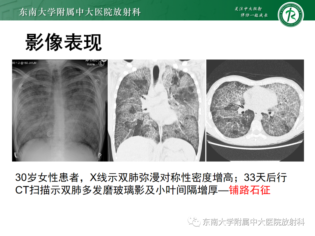 影像PPT - 【PPT】肺泡蛋白沉积症-15