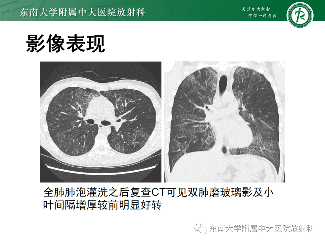 影像PPT - 【PPT】肺泡蛋白沉积症-16