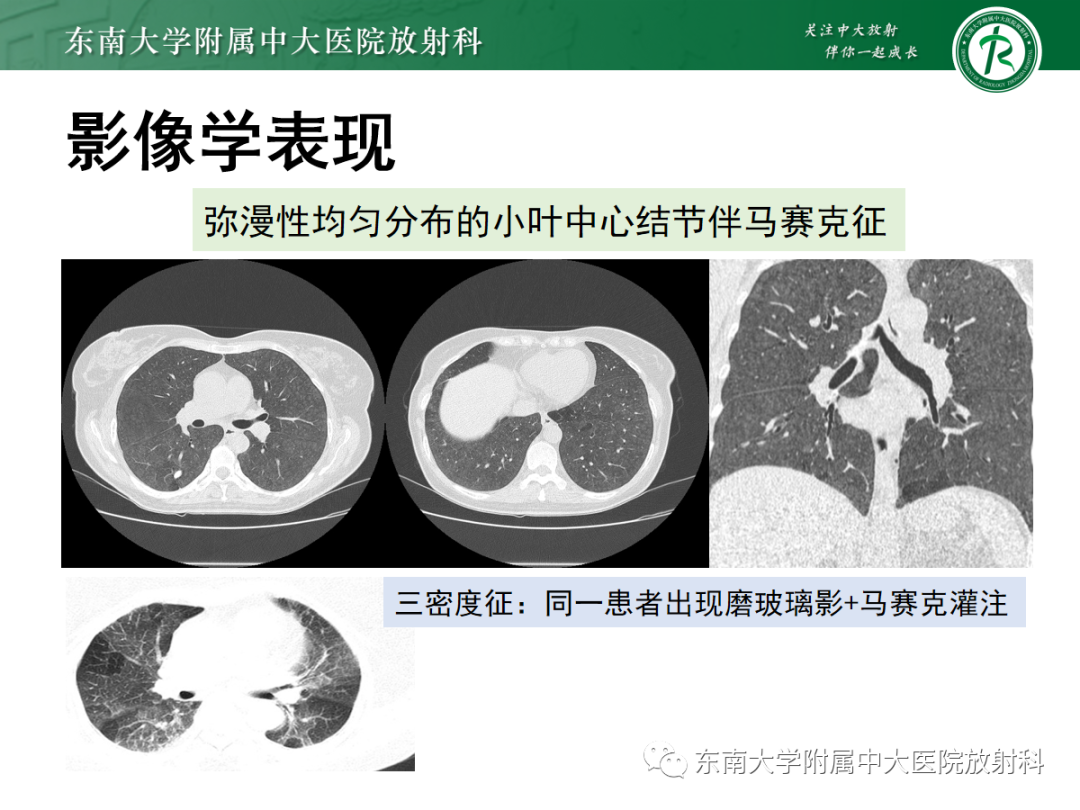 影像PPT - 【PPT】肺泡蛋白沉积症-20