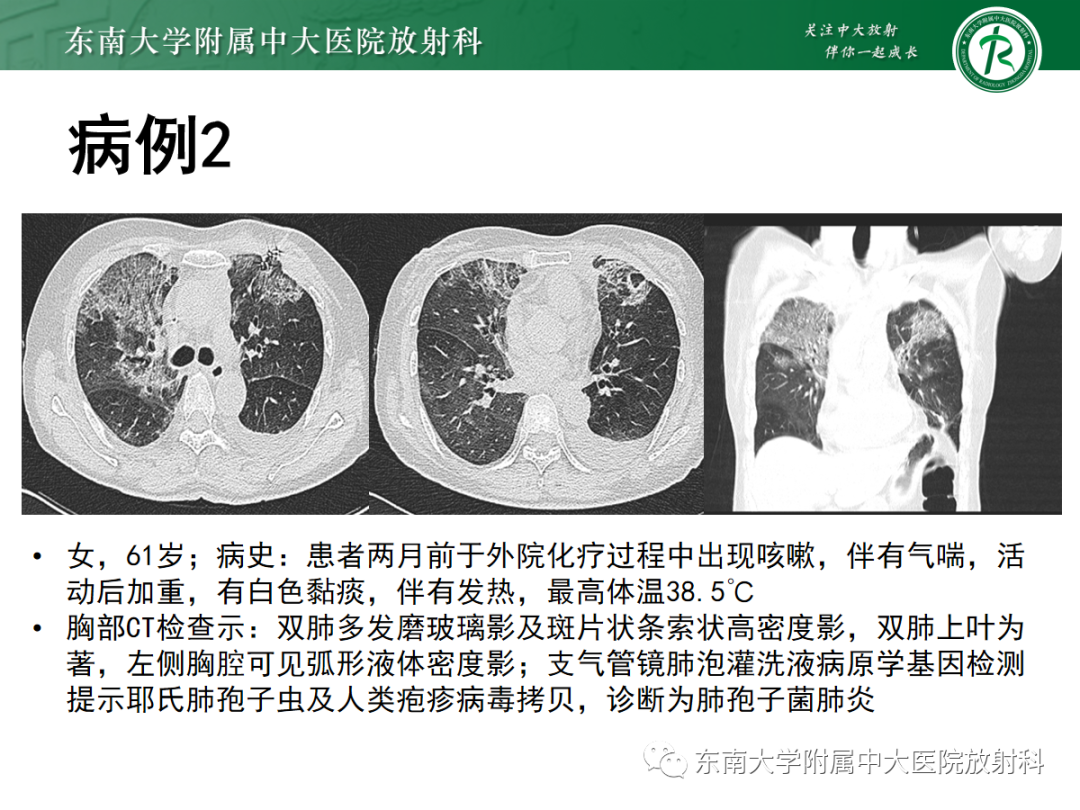 影像PPT - 【PPT】肺泡蛋白沉积症-21