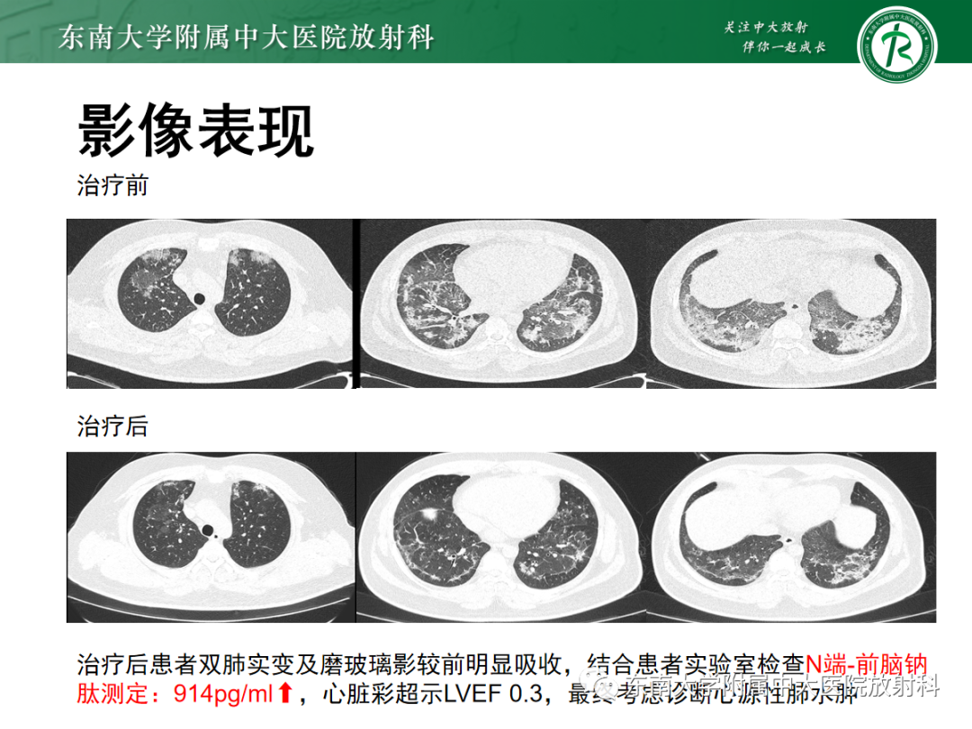 影像PPT - 【PPT】肺泡蛋白沉积症-25
