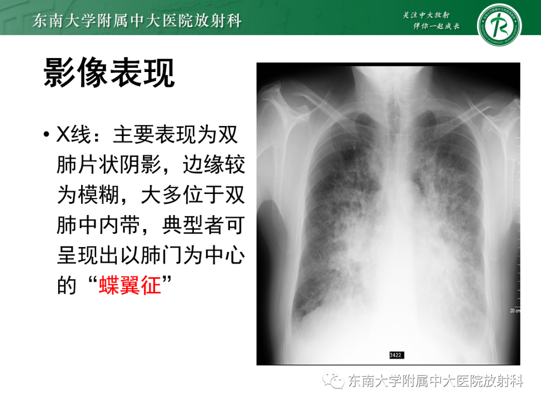 影像PPT - 【PPT】肺泡蛋白沉积症-27