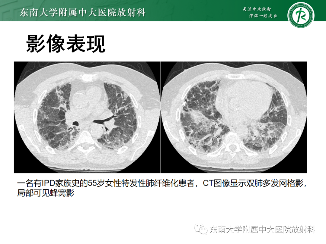 影像PPT - 【PPT】肺泡蛋白沉积症-33