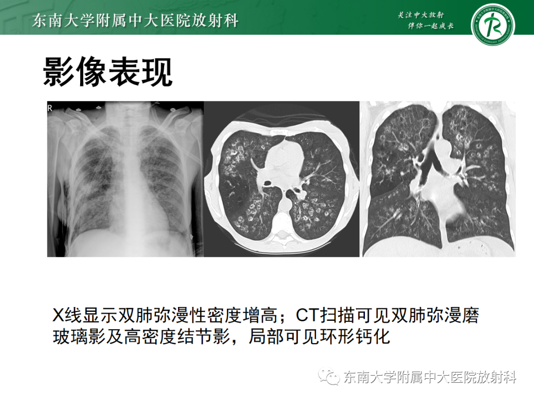 影像PPT - 【PPT】肺泡蛋白沉积症-36