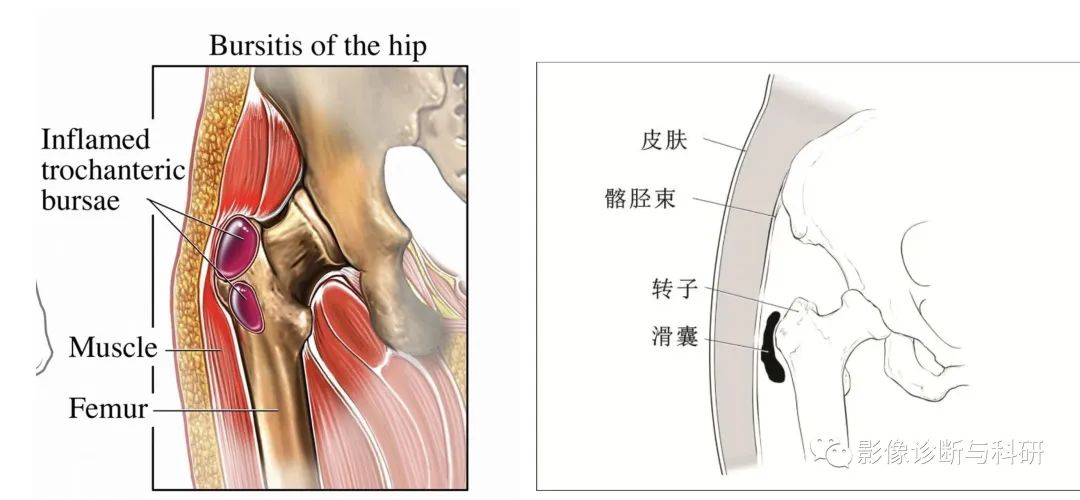 影像PPT - 股骨大转子疼痛综合征(滑囊炎)影像表现-1 影像PPT - 股骨大转子疼痛综合征(滑囊炎)影像表现-1