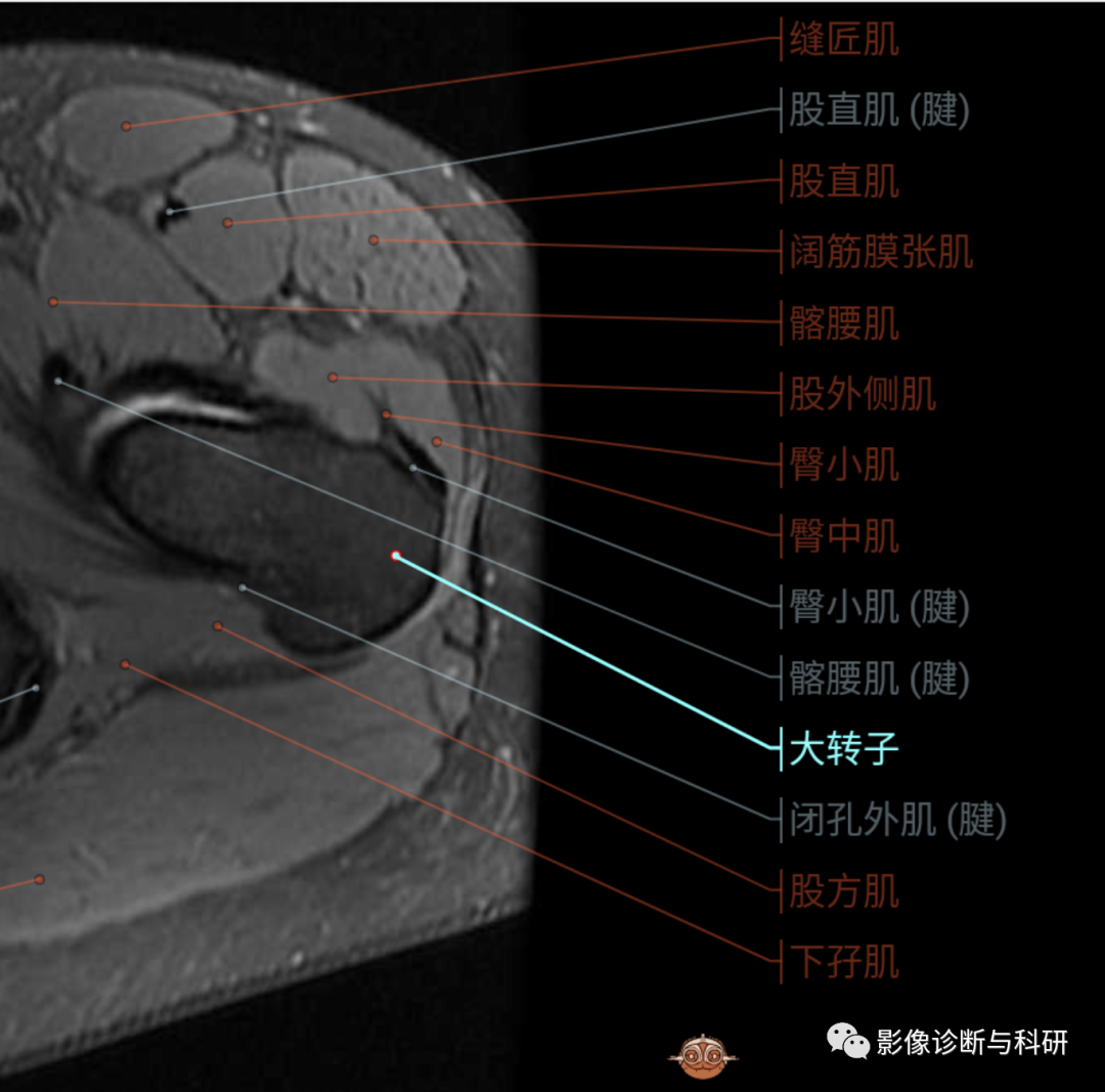 影像PPT - 股骨大转子疼痛综合征(滑囊炎)影像表现-2 影像PPT - 股骨大转子疼痛综合征(滑囊炎)影像表现-2