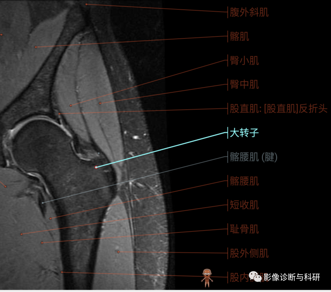 影像PPT - 股骨大转子疼痛综合征(滑囊炎)影像表现-4 影像PPT - 股骨大转子疼痛综合征(滑囊炎)影像表现-4