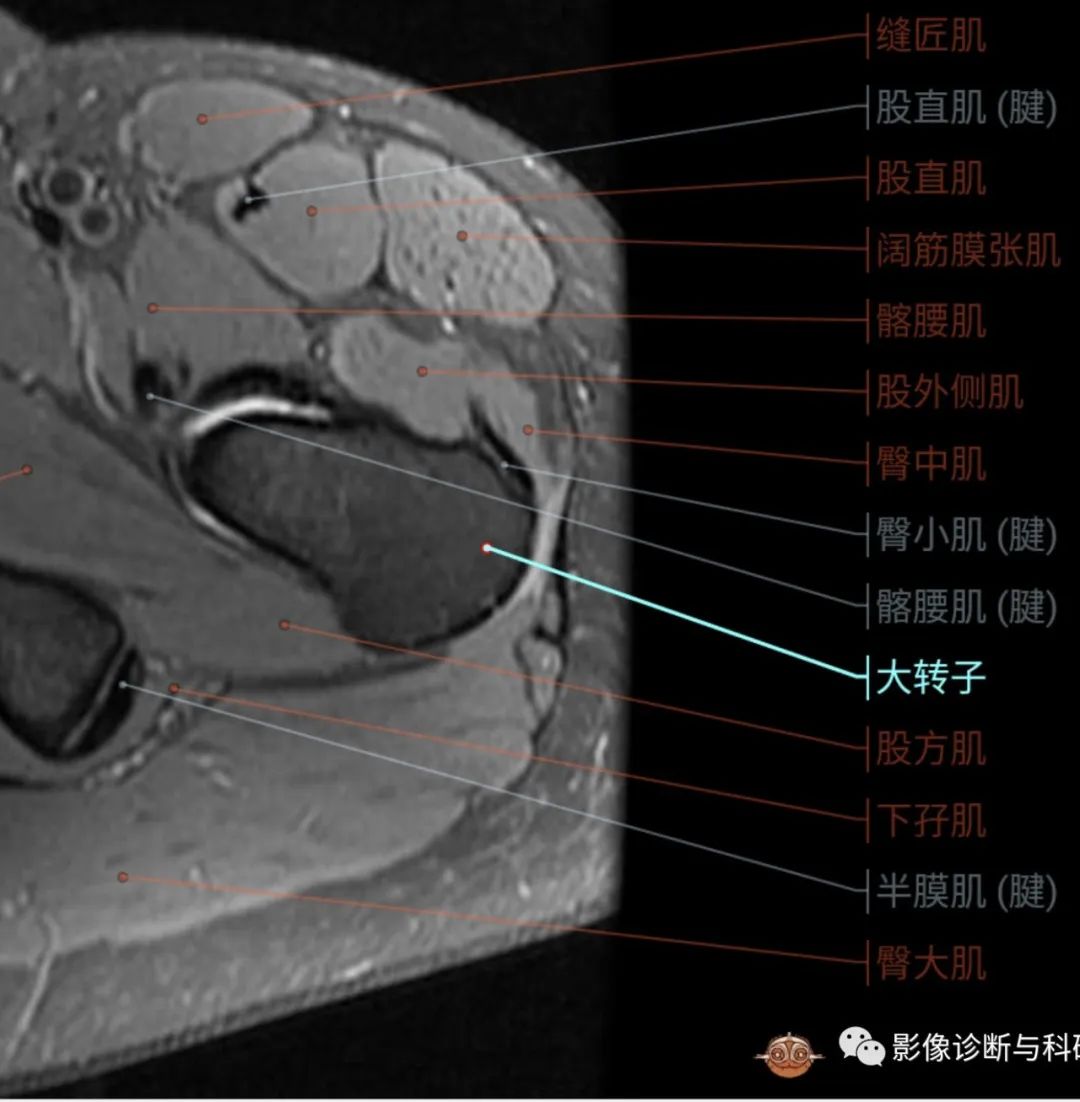 影像PPT - 股骨大转子疼痛综合征(滑囊炎)影像表现-3 影像PPT - 股骨大转子疼痛综合征(滑囊炎)影像表现-3
