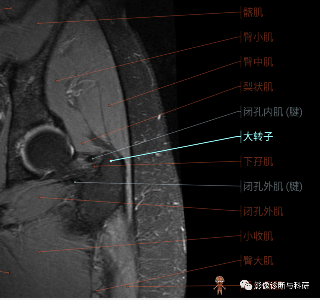影像PPT - 股骨大转子疼痛综合征(滑囊炎)影像表现-5 影像PPT - 股骨大转子疼痛综合征(滑囊炎)影像表现-5