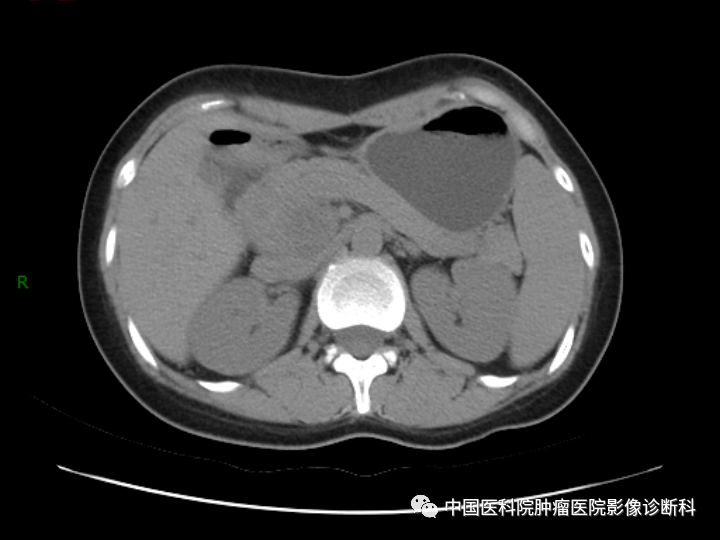 影像PPT - 【病例】胰腺神经内分泌肿瘤1例CT及MR影像-2 影像PPT - 【病例】胰腺神经内分泌肿瘤1例CT及MR影像-2
