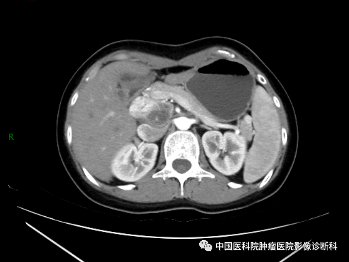 影像PPT - 【病例】胰腺神经内分泌肿瘤1例CT及MR影像-3 影像PPT - 【病例】胰腺神经内分泌肿瘤1例CT及MR影像-3