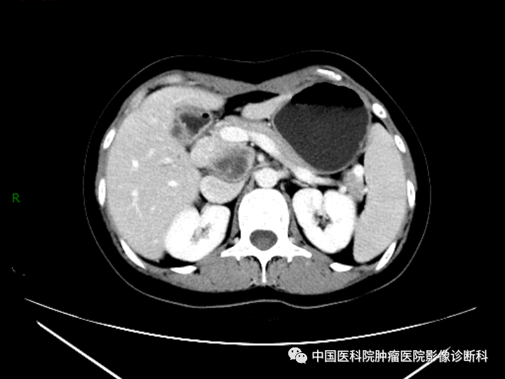 影像PPT - 【病例】胰腺神经内分泌肿瘤1例CT及MR影像-4 影像PPT - 【病例】胰腺神经内分泌肿瘤1例CT及MR影像-4