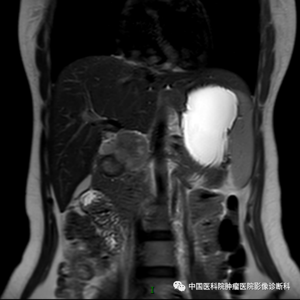 影像PPT - 【病例】胰腺神经内分泌肿瘤1例CT及MR影像-7 影像PPT - 【病例】胰腺神经内分泌肿瘤1例CT及MR影像-7