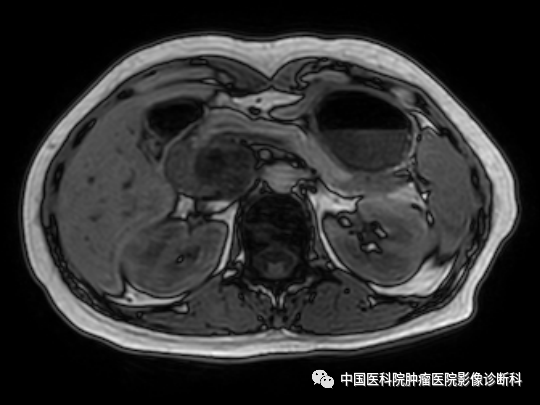 影像PPT - 【病例】胰腺神经内分泌肿瘤1例CT及MR影像-6 影像PPT - 【病例】胰腺神经内分泌肿瘤1例CT及MR影像-6