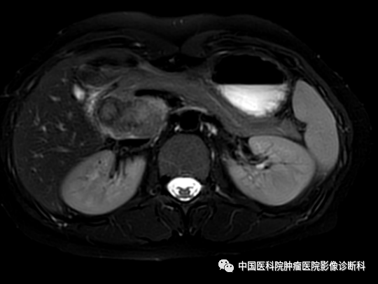 影像PPT - 【病例】胰腺神经内分泌肿瘤1例CT及MR影像-8 影像PPT - 【病例】胰腺神经内分泌肿瘤1例CT及MR影像-8