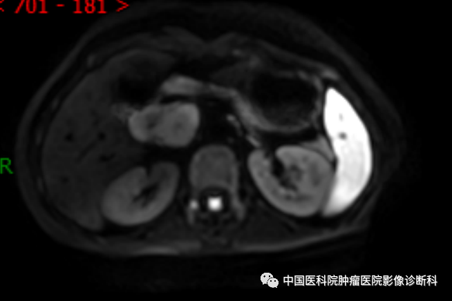 影像PPT - 【病例】胰腺神经内分泌肿瘤1例CT及MR影像-9 影像PPT - 【病例】胰腺神经内分泌肿瘤1例CT及MR影像-9
