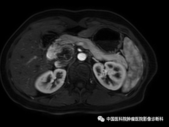 影像PPT - 【病例】胰腺神经内分泌肿瘤1例CT及MR影像-10 影像PPT - 【病例】胰腺神经内分泌肿瘤1例CT及MR影像-10